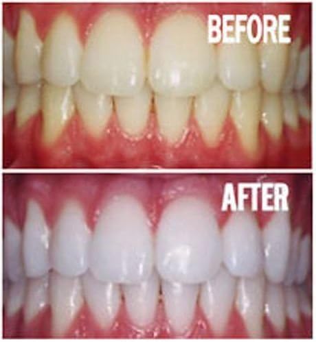 Bright White Smiles - Teeth Whitening Gel Refill Kit - 10 Tubes 44% Carbamide Peroxide Tooth Whitener Formula