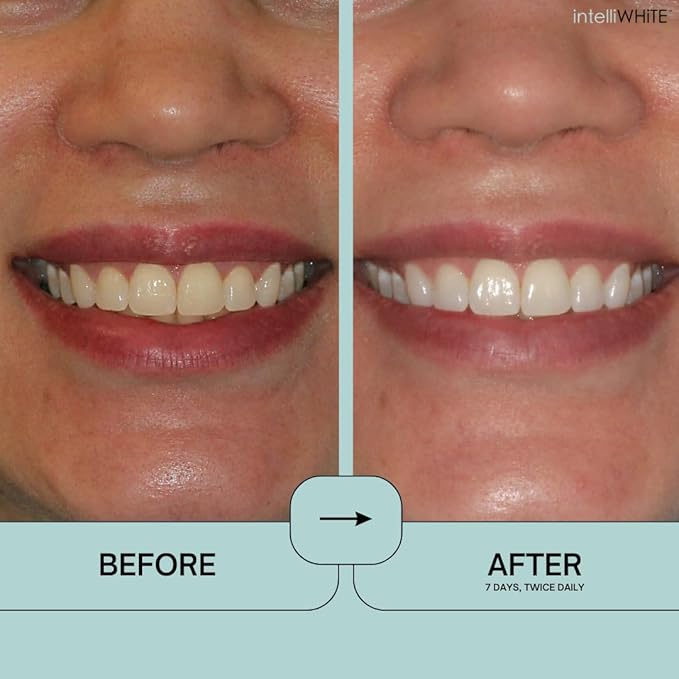 Prostrips - 12 Shades Whiter Teeth - 28 Enamel Safe REMINERALIZING Gentle Strips – 97% no Sensitivity