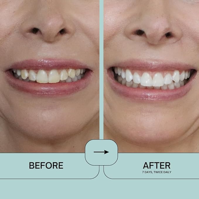 Prostrips - 12 Shades Whiter Teeth - 28 Enamel Safe REMINERALIZING Gentle Strips – 97% no Sensitivity