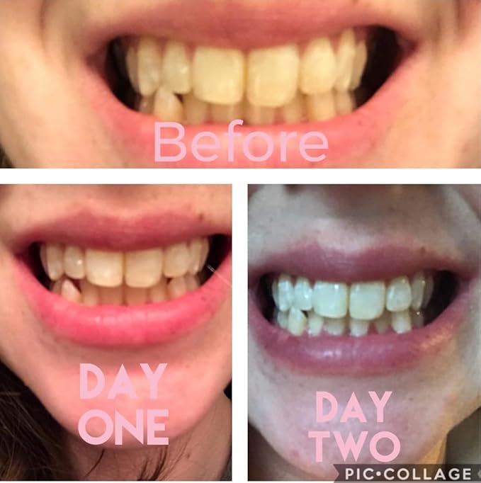 Teeth Whitening Gel Refill 4X Syringes 44% Carbamide Peroxide