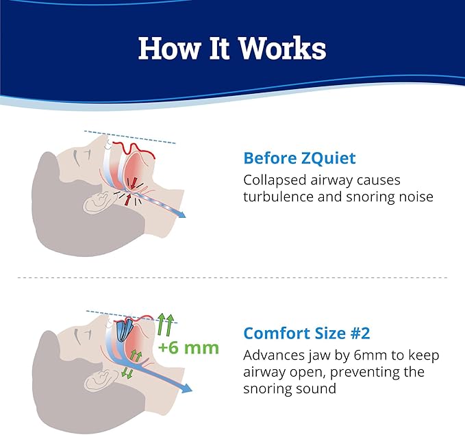 ZQuiet Anti-Snoring Mouthpiece Solution - Comfort Size #2 (Single Device) + Cleaner (1.5oz Bottle) - Made in USA Snoring Solution for a Better Night’s Sleep (Blue)