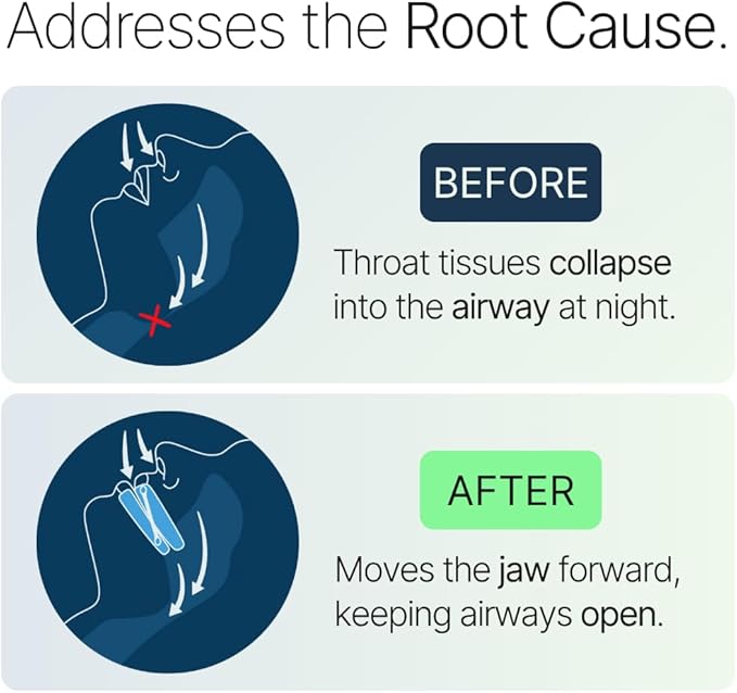 Somnofit-S Anti-Snore Mouth Guard by SnoreLessNow | Made in Switzerland | FDA Cleared | Most Comfortable Anti Snoring Mouthpiece | Sleep Tight Mouth Guard | Adjustable Snoring Solution for Men & Women