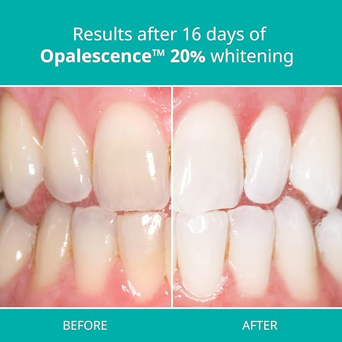 Opalescence 20% with PF Whitening Whitening Refill Kit (8 Syringes) Carbamide Peroxide. Made by Ultradent, in Melon Flavor. Tooth Whitening Refill Syringes - B-5401-4