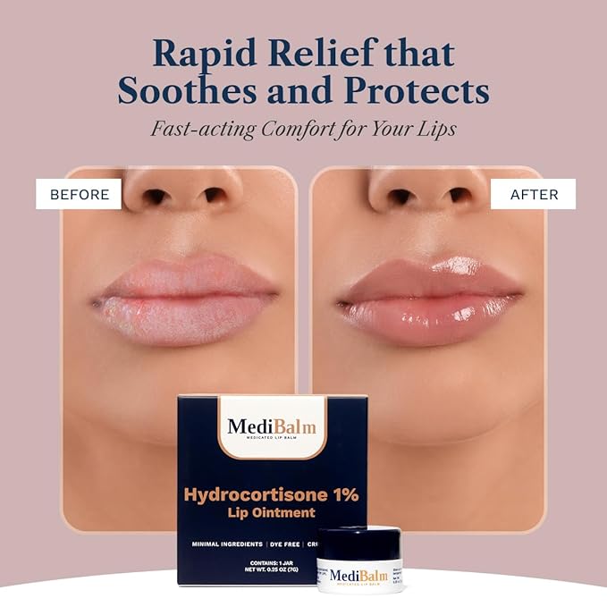 1% Hydrocortisone Lip Balm – Petrolatum-Free Relief for Chapped, Dry, or Irritated Lips due to Accutane, Isotretinoin associated Cheilitis, Weather Damage, and more - Unflavored