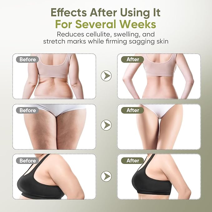 Lymphatic Drainage Massager & Anti Cellulite Massage Tool — Body Sculpting Machinefor Legs, Arms & Belly, Body,Helps Reduce Stretch Marks & Cellulite,with Microcurrent, Light Heat & Vibration
