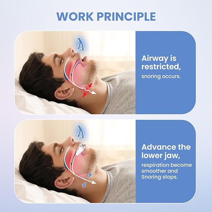 S martGuard Anti-Snore Device: Anti-Snoring Device for Stop Snoring Solution for Men and Women-U01