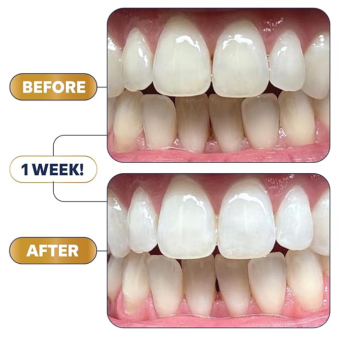 Lumineux 2-in-1 Whitening Pen (1 Pack) Enamel Safe and Clinically Proven to Whiten Without The Sensitivity - Removes Coffee, Tea, and Smoking Stains