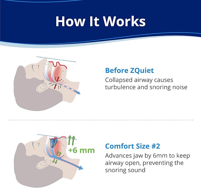 ZQuiet, Anti-Snoring Mouthpiece, Comfort Size #2, Single Refill, Blue Made in USA, BPA-Free, Medical-Grade Material