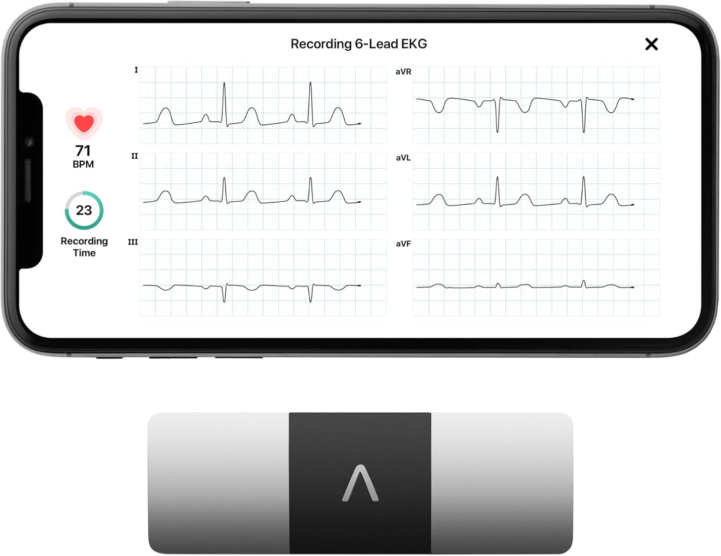KardiaMobile 6-Lead Personal EKG Monitor – Six Views of The Heart – Detects AFib and Irregular Arrhythmias – Instant Results in 30 Seconds – Works with Most Smartphones