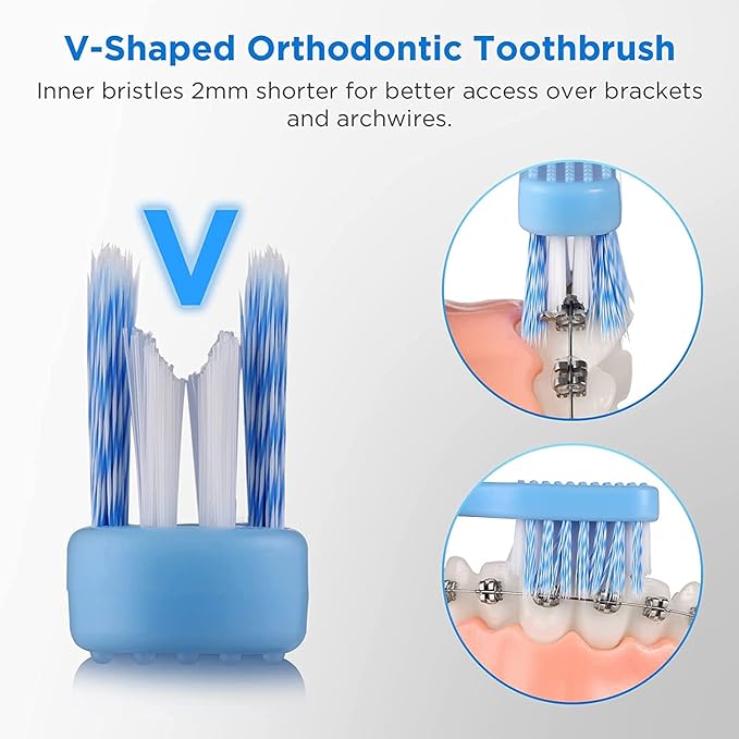V-Shaped Orthodontic Toothbrush for Braces, Soft Bristles, 6 Count, with Interdental Brushes