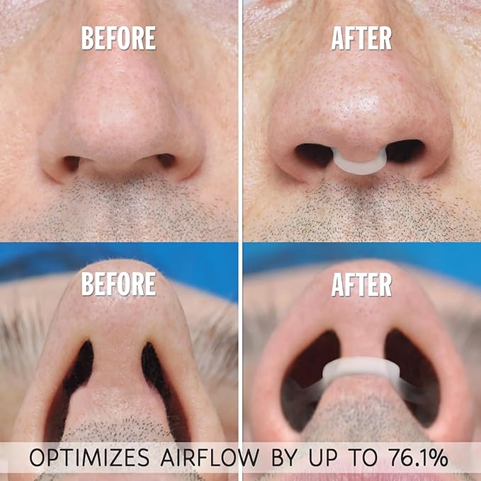 Nasal Dilators for Snoring (Blue)