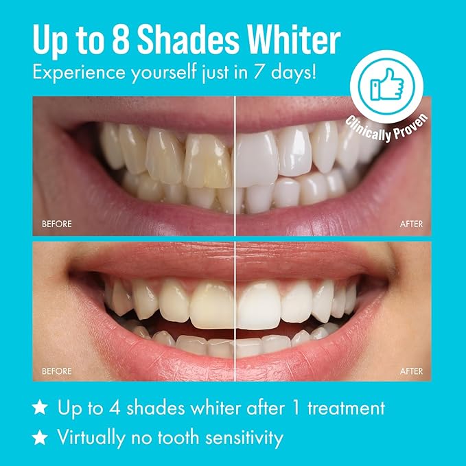 Cali White Teeth Whitening Strip Kit with LED Light and Batteries - Organic Peroxide Teeth Whitener Gel - Set of White Strips - 2x5ml Syringes, Thermoform Whitening Kit Trays and Case