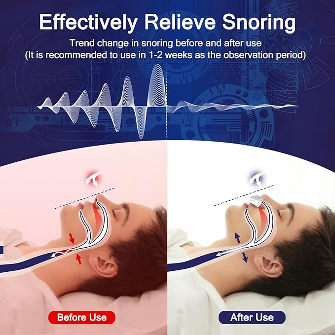 Anti Snoring Device, Adjustable Wind Speed Snoring Solution, Electric Anti Snoring Devices Nasal Dilator Nose Vents Plugs,Stop Snoring Suitable for Men & Women,White