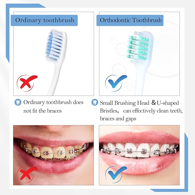 Honeydak 6 Pieces V Shaped Orthodontic Toothbrush for Brace with Brush Head 40 Pieces Interdental Brush Soft Bristle Braces Brushes for Cleaning Portable Toothbrushes for Braces(Small,Yellow)