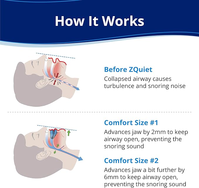 ZQuiet, Anti-Snoring Mouthpiece (Blue) + Cleaner (1.5oz Bottle), Starter Pack with 2 Sizes, Made in USA, BPA-Free, Medical-Grade Material, Clear