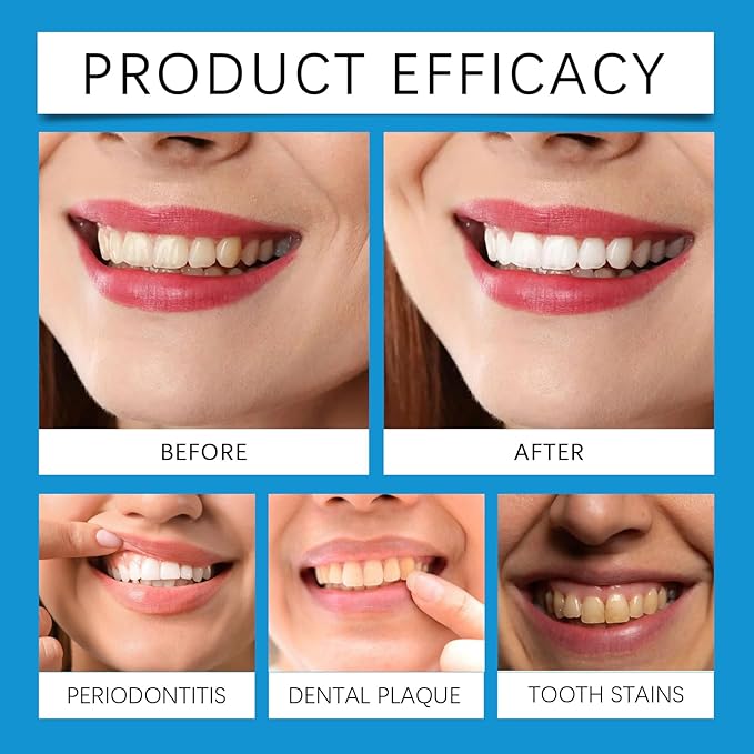 Advanced Technology Teeth Whitening Kit with LED Light, Natural Extracts, Professional Quality