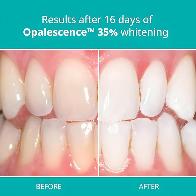 Opalescence 35% Gel Syringes Teeth Whitening - Refill Kit (4 Syringes Total) Carbamide Peroxide. Made by Ultradent, in Melon Flavor. Tooth Whitening Refill Syringes 5404-1