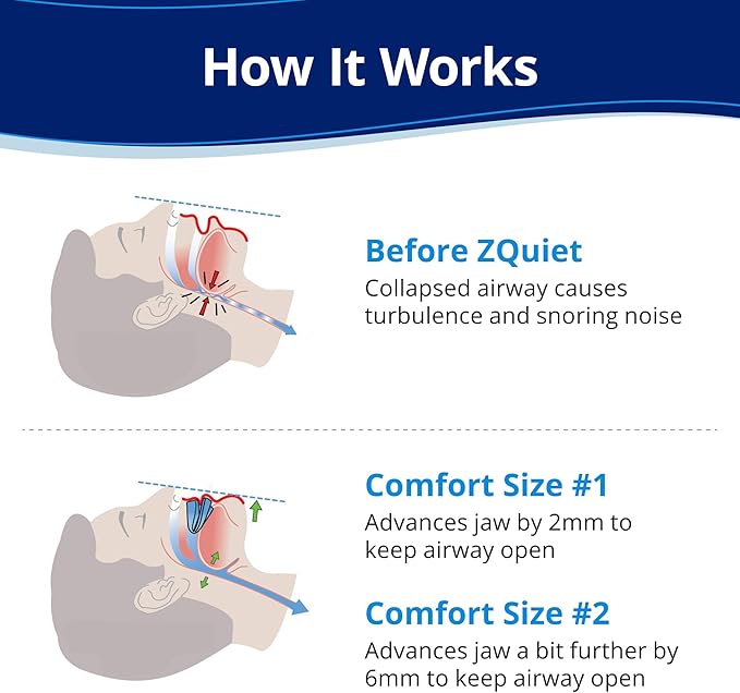 ZQuiet, Anti-Snoring Mouthpiece, Starter Pack with 2 Sizes, Living Hinge & Open Front Design for Comfort & Easy Breathing, Clear