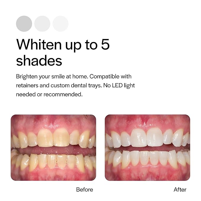 Opalescence 35% Gel Syringes Teeth Whitening - Refill Kit (12 Syringes), Made by Ultradent, Carbamide Peroxide in Mint Flavor. Tooth Whitening 5197-12