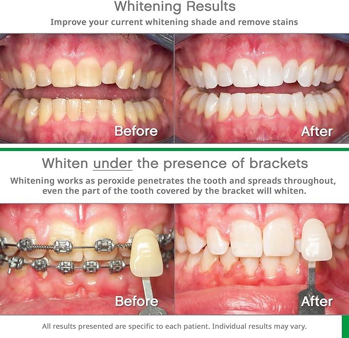 Opalescence Whitening Bundle - Opalescence Go 10% Hydrogen Peroxide Prefilled Whitening Trays and Whitening Toothpaste - Mint Flavor 5194-5166