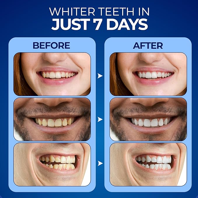 Premium Teeth Whitening Kit with a Rechargeable Wireless Red and Blue UV Whitening Spectrum LED Lights Accelerator Mouthpiece, a Sanitizing Travel Storage Case & Three 2 ml Whitening Gel Pen