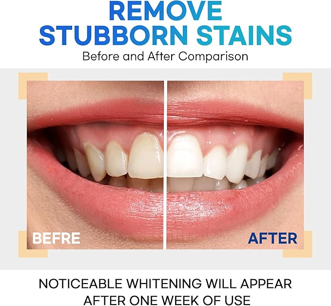 Teeth Whitening Gel – Set of 3 – Gentle, Pain-Free Formula for Sensitive Teeth – Easy, Mess-Free Application – Travel-Friendly & Enamel-Safe for a Brighter Smile