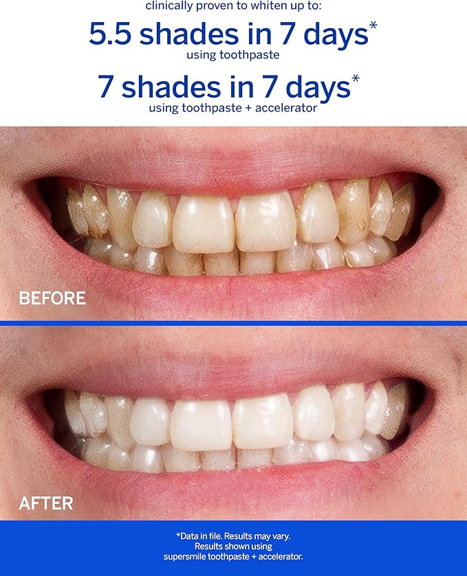 Supersmile Professional Whitening Toothpaste w/ Fluoride - Removes Stains & Whitens Teeth 6 Shades - Enamel Strengthening - No Sensitivity - Travel Size (Original Mint, 1.4 Oz)